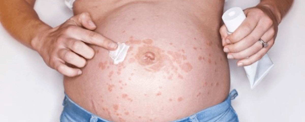 Women applying ointment to get rid of PUPPP rash